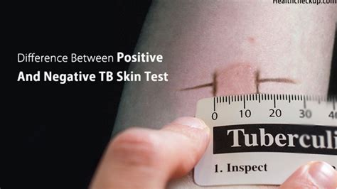 what does a positive tb test look like|TB Skin Test: Uses, Procedure, and Results.